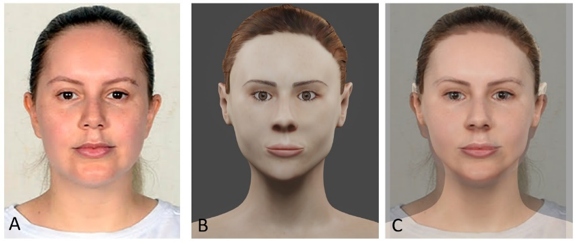 Comparação com a aproximação facial bidimensional realizada com técnicas da aproximação facial 3D digital. Imagens escalonadas